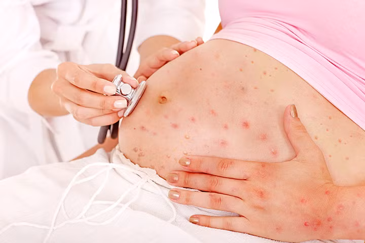 Viêm phổi và loạt biến chứng nguy hiểm của thủy đậu ở bà bầu - Hình 2 Viem phoi va loat bien chung nguy hiem cua thuy dau o ba bau-Hinh-2
