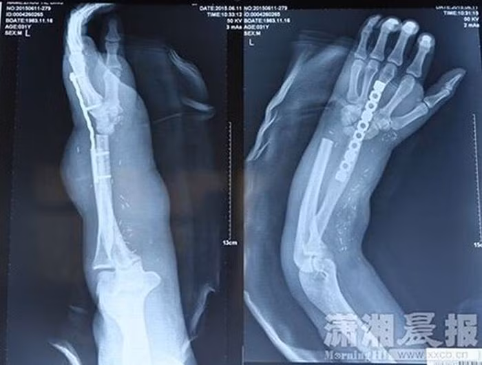 Zhou đã được đưa tới bệnh viện Xiangya để chữa trị. Tuy nhiên do bàn tay và cả cánh tay của anh đã bị thương nặng, các bác sỹ không thể nối ghép tay lại cho anh ngay nên phải nối bàn tay bị cắt rời vào chân bên phải của anh để các dây thần kinh và gân có thời gian hồi phục.
