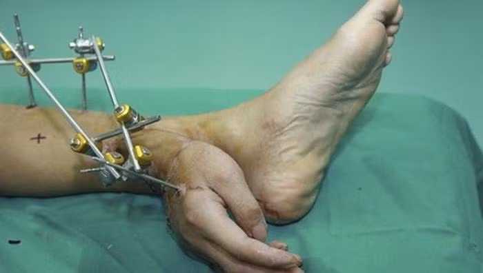 Bàn tay của anh Zhou đã được cứu sống và dần hồi phục nhờ được gắn vào chân trong suốt 1 tháng.