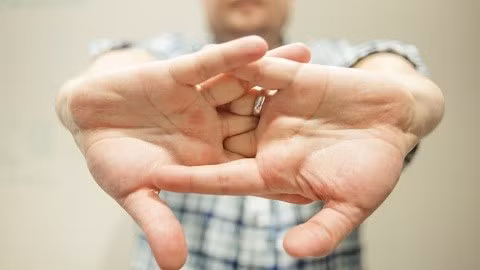 Ngoài ra, sự cọ sát mạnh thường xuyên liên tục có thể làm hao mòn mặt khớp, dẫn tới nguy cơ thoái hóa, viêm mặt sụn khớp.