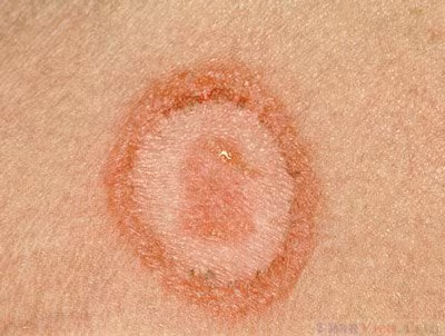 Theo thông tin đăng tải trên trang viện y học ứng dụng, bạn hoàn toàn có nguy cơ bị herpes mảng tròn khiến da bạn bị phát ban đóng vảy thành những nốt đỏ, tròn trên da hoặc một mảng hói trên da đầu.