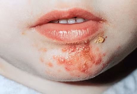 2. Rửa vết thương, chỗ lở loét: Pha loãng 1 phần dịch tỏi và 10 phần nước cất, thêm 2% cồn để bảo quản. Ảnh: dinhduongsuckhoe.vn.