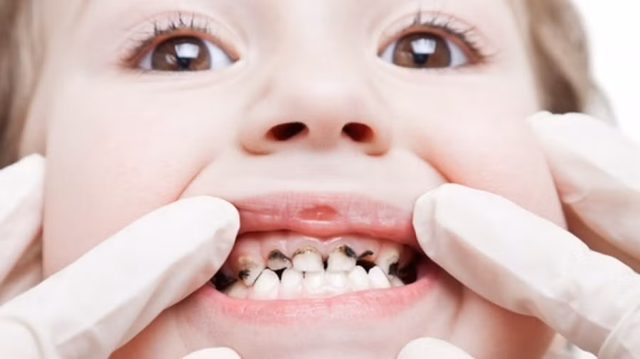 5. Trị sâu răng, nhức răng:Mẹ dùng quả bồ kết tán nhỏ, sau đó đem đắp vào chân răng của con, nếu chảy nước dãi thì nhổ đi. Hoặc dùng bột bồ kết đốt tồn tính rồi nhét vào chân răng. Ảnh: me.phununet.com.