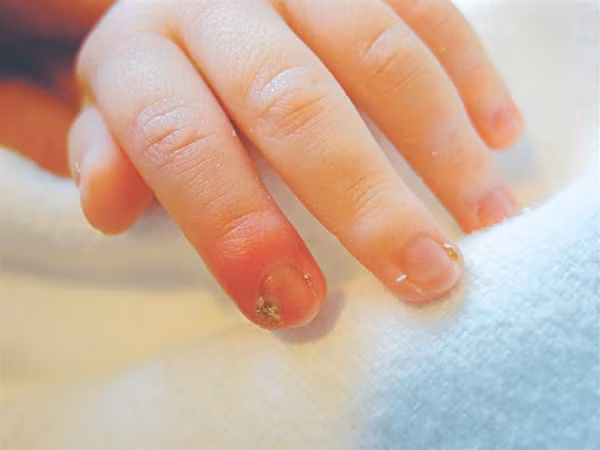 Chữa chín mé: Dùng sáp ong và nhựa thông lượng bằng nhau nấu cho tan rồi bôi vào đầu ngón chân, ngón tay chữa chín mé...Ảnh: suckhoedoisong.vn.
