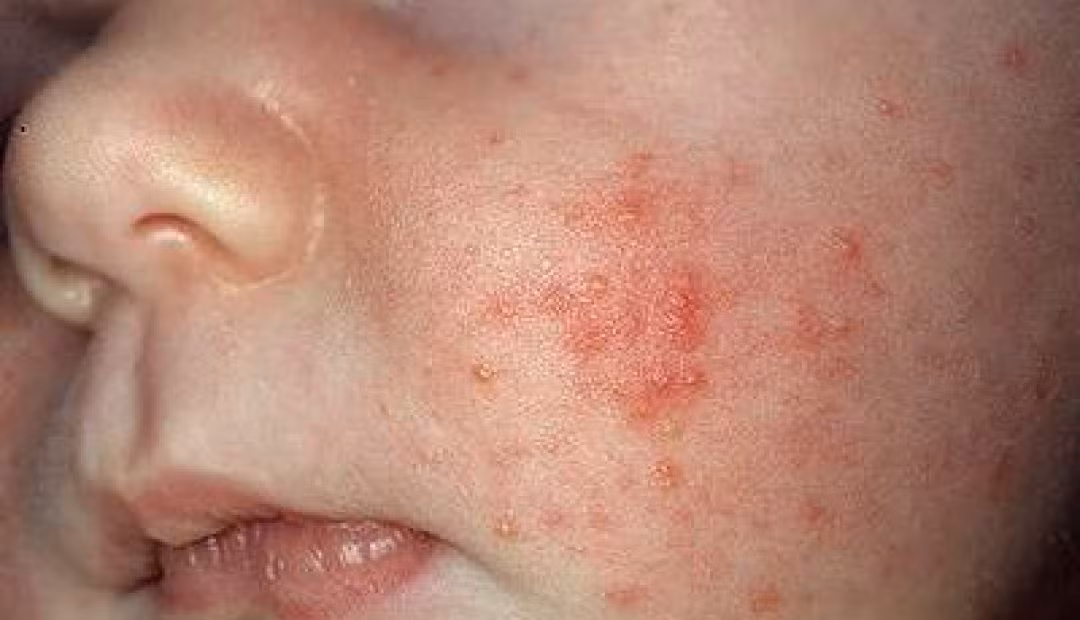 2. Bệnh hạt kê ở trẻ. Mụn kê thường xuất hiện trên má, đôi khi ở trên trán, cằm, chân tay và cả lưng. Những nốt mụn này có thể bị bao bọc bởi một vùng da hơi tấy đỏ và sẽ càng đỏ tấy hơn khi cơ thể bé nóng lên hay khi da bị kích thích do tiếp xúc với nước bọt, sữa mẹ cũng như các chất tẩy rửa. Ảnh: Conlatatca.vn.