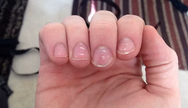 6. Có vệt trắng trên móng: Trên móng bé xuất hiện một số vệt trắng có thể hằn sâu và móng. Điều này chứng tỏ bé đã bị thiếu hụt chất lâu dài, phần đáy móng có thể bị bong tróc 1 phần vẩy. Chất bé đang thiếu hụt là đạm, kẽm hoặc vitamin B12, omega3. Ảnh: gpcare.vn.