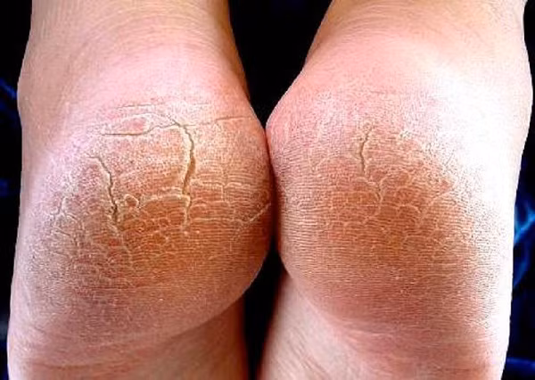 6. Điều trị bàn chân bong nứt: Mỗi tối trước khi đi ngủ nên ngâm chân nước ấm, sau đó lau khô chân, bôi xức chút dầu gió lên vùng da bị bong tróc. Mỗi ngày thực hiện một lần, áp dụng khoảng 5 lần liên tiếp. Ảnh: benhvaynenasung.com.