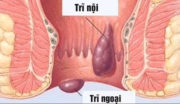 Sáp ong được dùng để chữa trĩ ra máu: Kết hợp với nha đam tử. Ảnh: khamhaumon.com. 