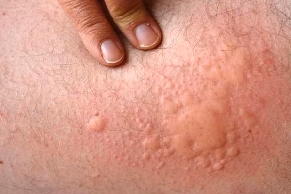 Cách 3: Dùng 100g Lá đơn đỏ và 100g tầm phỏng đun sôi với 3 lít nước. Dùng nước này để tắm hoặc vệ sinh vùng da bị mề đay hàng ngày. Ảnh: dominhduong.vn.