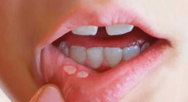 3. Nước chiết mướp đắng ướp đường: Mướp đắng tươi 1 – 2 quả. Mướp đắng rửa sạch, nghiền nhuyễn, cho thêm 100g đường trắng trộn khuấy đều để sau 2 giờ đem khuấy nước sôi nguội và lọc lấy nước cho uống 1 lần. Dùng cho chứng nhiệt lỵ. Ảnh: BonKid.com.vn.