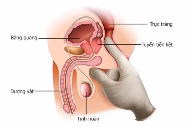 3. Chữa viêm tiền liệt tuyến cấp tính: Lá diếp cá tươi 60g, giã nát, đổ ngập nước vo gạo ngâm trong 1 giờ, sau đó bỏ bã, chia 2 lần uống trong ngày. Ảnh: benhvienanviet.com.