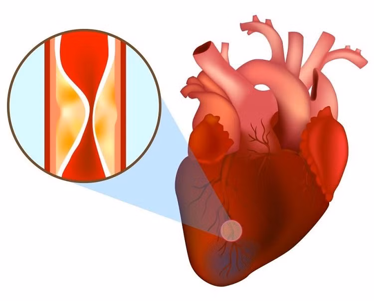 Nhồi máu cơ tim cũng có thể gây đau lan xuống vùng bụng, khiến người bệnh có cảm giác giống như bị ợ nóng do trào ngược dạ dày – thực quản. Ảnh: careplusvn.