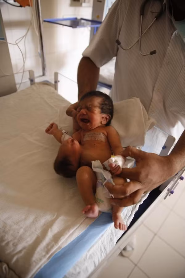 Đây là trường hợp có tên gọi là Hetropagus, thường được gọi là “sinh đôi ký sinh”. Em bé được sinh ra khỏe mạnh với nhịp tim bình thường. Bé không gặp phải bất kỳ tình trạng phức tạp nào thêm ở bên trong hoặc bên ngoài cơ thể và điều này làm tăng cơ hội sống sót của bé. Tuy nhiên, thật không may khi bé sinh ra lại có một chiếc đầu thứ hai mọc ra từ bụng.