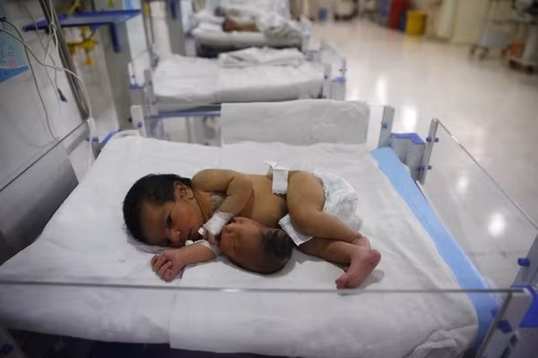 Xót thương bé sơ sinh có đầu mọc ở bụng. Một bé gái Ấn Độ chào đời hồi tháng 5/2014 với một thân thể không bình thường khi có một chiếc đầu thứ hai mọc ở bụng. Đây là hậu quả của việc thai nhi song sinh phát triển không hoàn thiện.