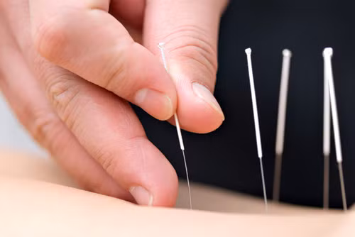 Xem xét liệu pháp châm cứu. Châm cứu có tác dụng điều tiết lưu lượng máu trong cơ thể, đặc biệt là đến vùng chậu giúp nâng cao chất lượng nội mạc tử cung. Đây được xem là sự lựa chọn hữu ích trong điều trị vô sinh. Nghiên cứu trước đó cũng cho thấy châm cứu có thể cải thiện hiệu quả của thụ tinh ống nghiệm, kích thích rụng trứng ở những phụ nữ không rụng trứng và cải thiện tình trạng đau bụng kinh.