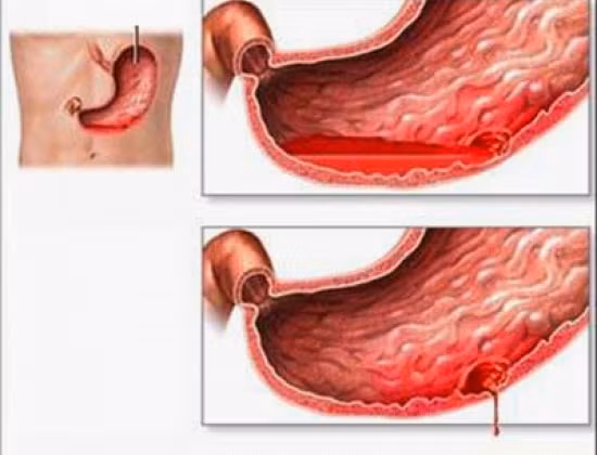 Thủng đường ruột: những bệnh nhân bị thủng đường ruột thường có biểu hiện điển hình là đau bụng cấp tính, cứng cơ bụng, ấn bị đau.