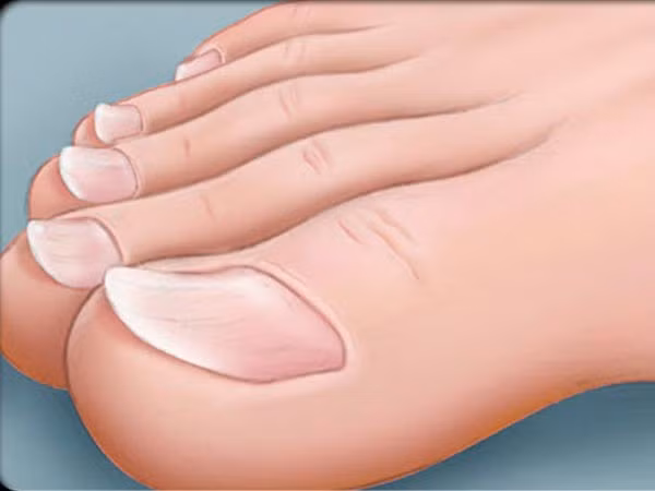 Móng mọc cong vếch ra ngoài dày lên bất thường. Đây có thể là dấu hiệu cảnh báo cơ thể thiếu sắt, thiếu máu, bệnh gan, tim hoặc máu lưu thông đến các ngón tay kém, thậm chí là các vấn đề về tuyến giáp.
