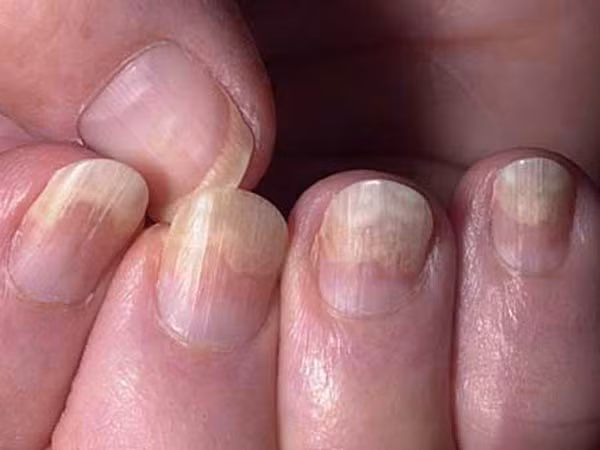 Móng tay lỏng lẻo. Móng tay bỗng trở nên lỏng lẻo và thậm chí có thể tách rời khỏi nền móng là dấu hiệu của bệnh tuyến giáp, suy tuần hoàn máu, tiểu đường tiên tiến, phản ứng dị ứng với thuốc...