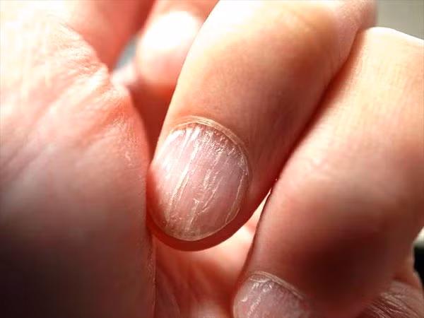Móng tay giòn và dễ gãy. Hiện tượng móng tay giòn và dễ gãy có thể là do chất tẩy rửa quần áo hoặc hệ quả của sự lão hóa. Tuy nhiên, móng tay giòn còn là dấu hiệu của bệnh nấm móng, các bệnh về tuyến giáp (hypothyroidism) và viêm khớp.