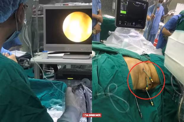 Tưởng đau bụng bình thường, hóa sỏi đường mật trong gan Tuong dau bung binh thuong, hoa soi duong mat trong gan