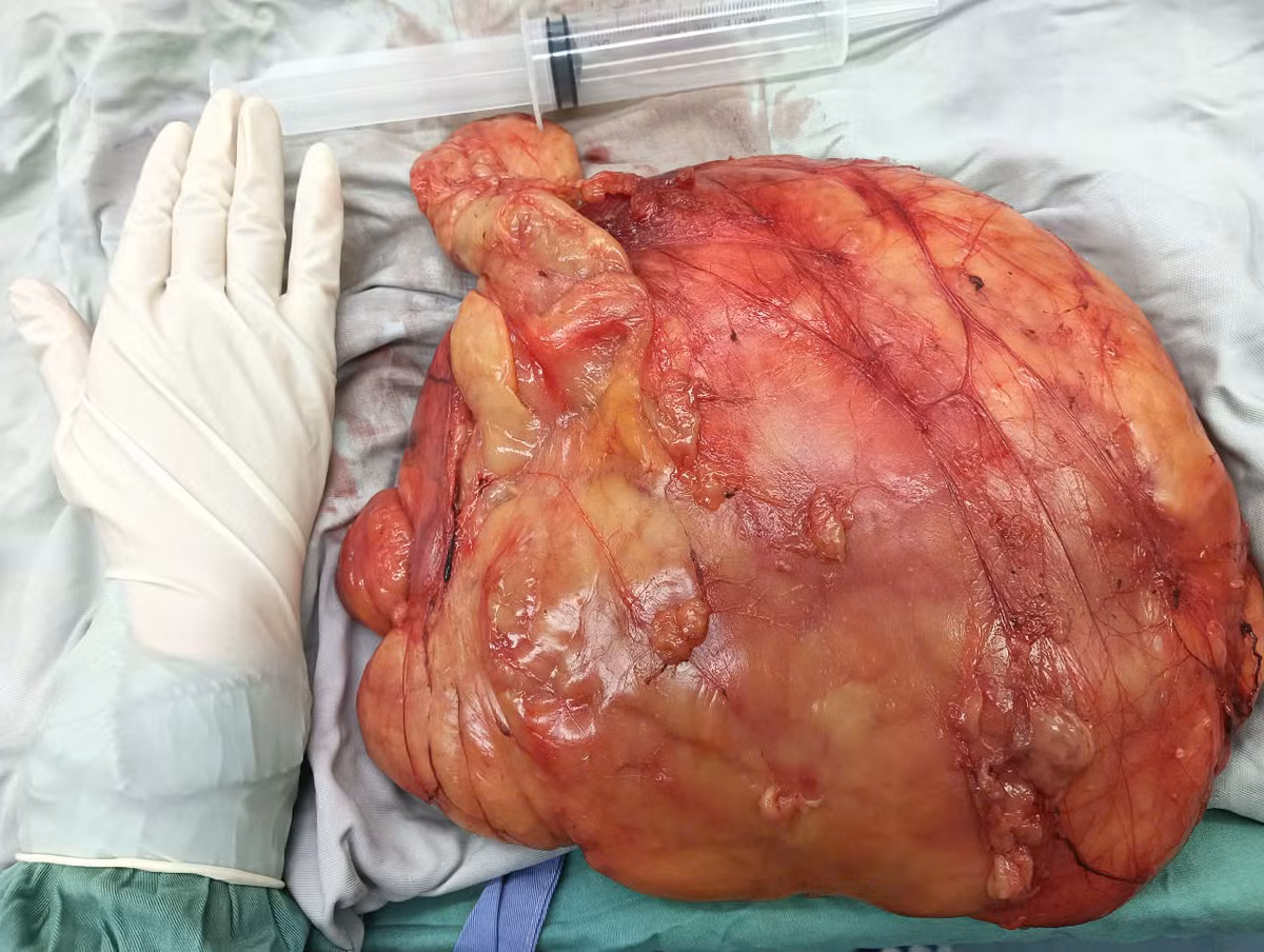 Phẫu thuật bóc khối u mỡ 5kg trong ổ bụng bệnh nhân 58 tuổi - Hình 2 Phau thuat boc khoi u mo 5kg trong o bung benh nhan 58 tuoi-Hinh-2