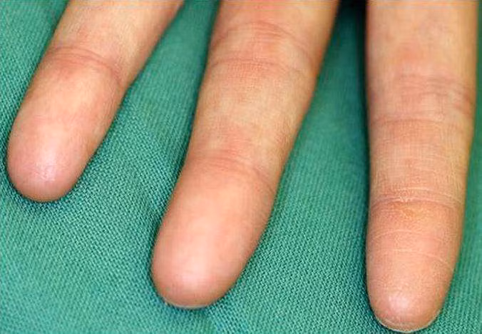 Những người mắc phải căn bệnh adermatoglyphia không có dấu vân tay. Những người mắc phải căn bệnh adermatoglyphia không có dấu vân tay.