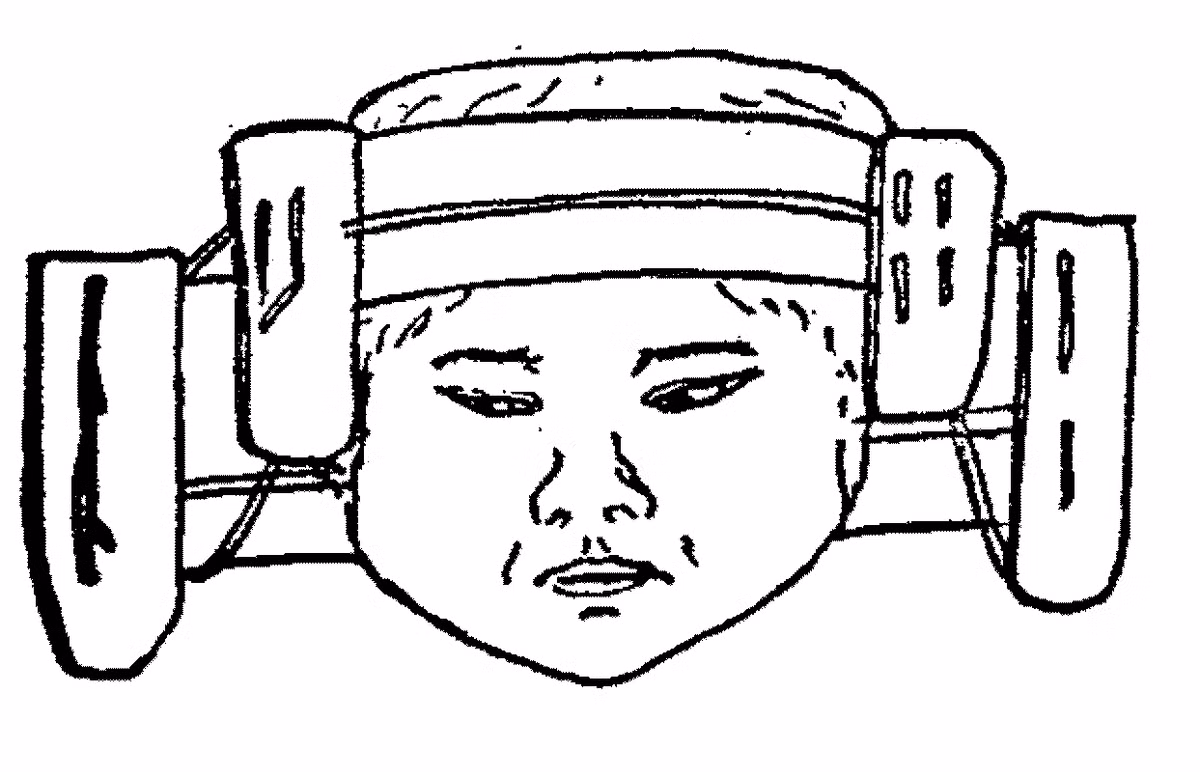 Tuy nhiên, một số trường hợp bị tổn thương não trong quá trình làm biến dạng hộp sọ. Theo đó, những đứa trẻ sẽ đối mặt với thương tật vĩnh viễn, thậm chí là tử vong.
