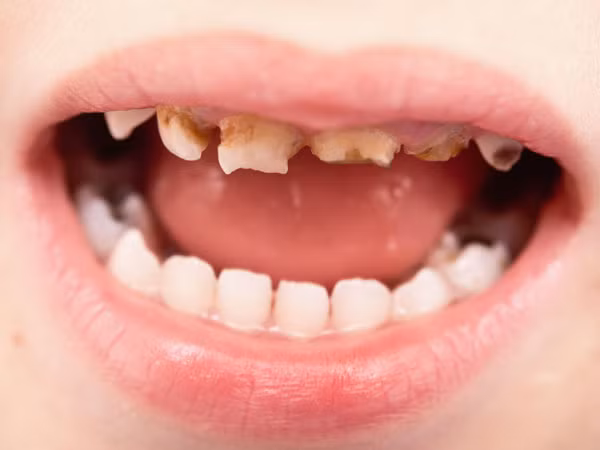 Bệnh tưa miệng là bệnh xảy ra do nấm men Candina và có thể bị nặng thêm nếu bạn bị tiểu đường hoặc đang dùng thuốc kháng sinh.