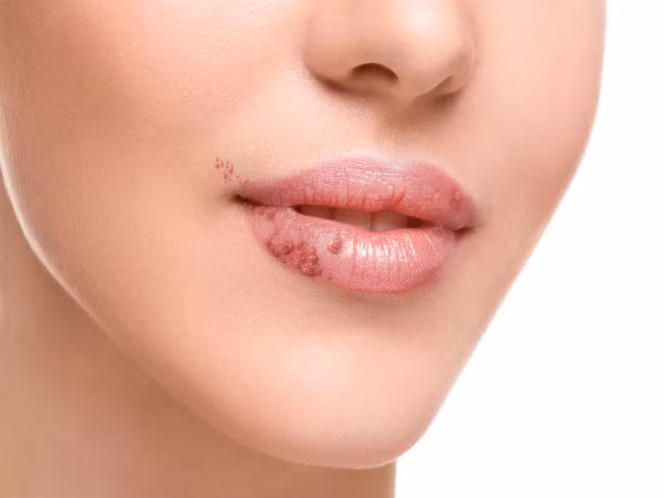 Vết lở miệng thường xuất hiện khi bạn bị sốt hoặc cảm lạnh. Đây cũng là một trong những dấu hiệu của bệnh truyền nhiễm có thể được điều trị dứt điểm bằng các loại thuốc. Tuy nhiên, nếu triệu chứng này xuất hiện thường xuyên, bạn cần đi kiểm tra sức khỏe càng sớm càng tốt.