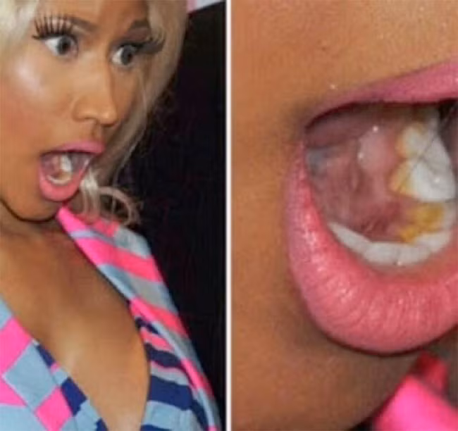 Nicky Minaj bị chê là răng miệng kém vệ sinh khi nữ rapper để lộ ra hàm răng đầy cao vàng khè.