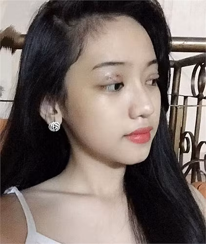 Tuy vẫn còn ngồi trên ghế nhà trường, Thúy Vi không ngần ngại công khai chuyện phẫu thuật thẩm mỹ. Để có được nhan sắc như hiện tại, cô nàng đã thực hiện cắt mí mắt và sửa mũi. Việt hot girl Thúy Vi công khai chuyện phẫu thuật thẩm mỹ trong khi còn ngồi trên ghế nhà trường khiến nhiều người bất ngờ.