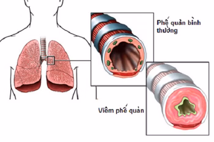 Viêm khí quản mãn tính. Mỗi lần dùng một con dơi, làm sạch lông, bỏ đầu, chân, ruột, gan chỉ lấy thân. Cho thêm 250g dầu vừng và ninh nhừ. Khi đã nhừ, lọc lấy phần nước dùng để nấu với các loại rau ăn. Ảnh: Thuocgiatruyenbaophuc.