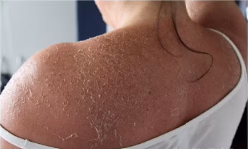 Theo các bác sĩ, các loại hóa chất được dùng để xóa xăm chứa thành phần chủ yếu là axit. Các axit này có khả năng tấn công vào các tế bào da, tàn phá, làm ăn mòn vùng da có hình xăm, loại bỏ mực xăm. Tuy nhiên, nếu không may mắn, người sử dụng có thể gặp phải những biến chứng kinh hoàng không mong muốn.