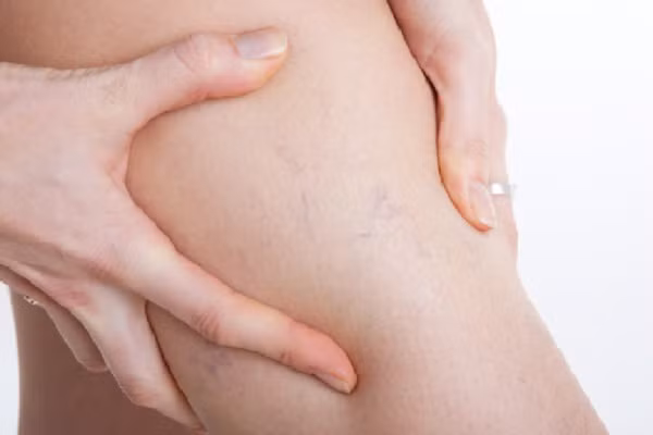 Nếu không được điều trị, các mạch máu tắc và thiếu oxy sẽ gây ra đột quỵ. Hoặc nếu không đến bệnh viện kịp thời, e rằng cô Jane sẽ phải cưa chân do các mạch máu bị ép vỡ và cơ bắp biến dạng. Ảnh: Diemtintrongngay.