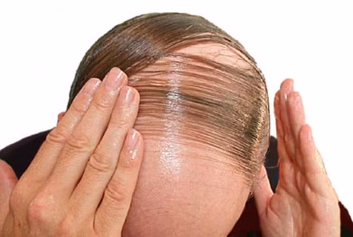 Khi hormone tuyến giáp tăng cao cũng khiến chu kỳ tăng trưởng tóc bị rối loạn khiến tóc yếu, mỏng và dễ gãy rụng. Ảnh: Hoidau.