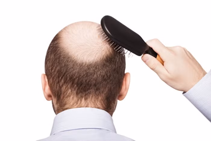 Rối loạn hệ miễn dịch. Chứng hói đầu cũng do một loại ban đỏ. Bệnh này khiến hệ thống miễn dịch mất khả năng nhận biết tác nhân lạ gây hại. Khi nhiễm lupus ban đỏ, hệ thống miễn dịch sẽ không giúp cơ thể chống lại sự xâm nhập của tác nhân lạ mà quay ra chống lại cơ thể bằng cách sinh ra các kháng thể kháng lại các tế bào của hầu hết các cơ quan như nang tóc nang lông làm cho nó không mọc được. Ảnh: Namkhoa.
