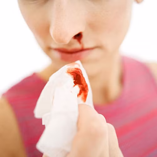 Chảy nước mũi một bên và có kèm theo máu cũng là một trong những dấu hiệu để chẩn đoán nguy cơ ung thư vòm họng. (Nguồn Songkhoe)