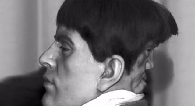 6. Người đàn ông có 2 khuôn mặt: Một người đàn ông có tên Edward Mordrake sinh ra với khuôn mặt thứ hai ở sau đầu. Khuôn mặt thứ hai này không thể nói nhưng có thể cười và khóc mà không hề liên quan đến cảm xúc của Edward Mordrake. Ông đã gọi khuôn mặt thứ hai của mình là khuôn mặt của quỷ. Edward Mordrake tự sát năm 23 tuổi sau khi các bác sĩ từ chối làm phẫu thuật tách khuôn mặt thứ hai khỏi đầu ông.
