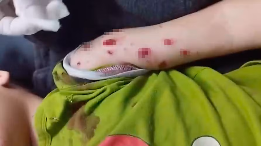 Bé trai 4 tuổi bị đa chấn thương do nhặt “vật lạ” phát nổ Be trai 4 tuoi bi da chan thuong do nhat “vat la” phat no