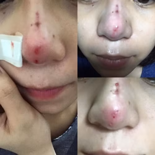Mũi chị Q sau hơn 2 tháng tiến hành thẩm mỹ chỉ.