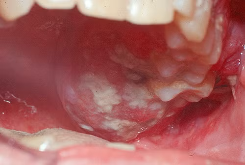 Ngoài ra, khi bị ung thư môi, một vị trí nào đó tại xương hàm có thể sưng to, làm cho mặt bị lệch. Ảnh: namlimxanh.