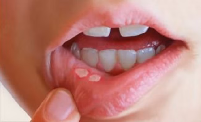 Thay đổi màu sắc da môi là một dấu hiệu khác của ung thư môi. Ảnh: ungthuvietnam.
