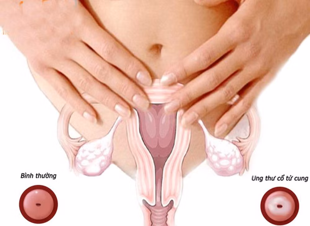 Giống như nhiều bệnh ung thư khác, dấu hiệu của ung thư cổ tử cung có thể bao gồm chán ăn và sụt cân.