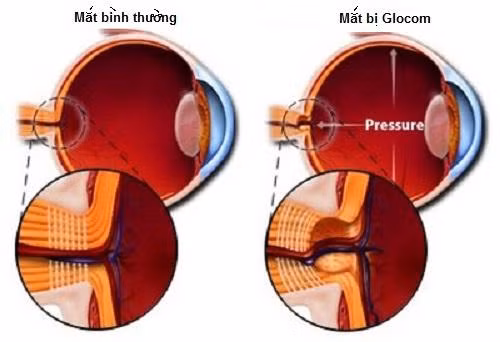 Bệnh glôcôm góc mở mắt: Căn bệnh này thường làm lõm teo gai thị và giảm thị lực muộn. Người bệnh thường khó phát hiện sớm ra bệnh vì dù có bệnh nhưng ban đầu mắt vẫn như bình thường không đỏ, không đau nhức.