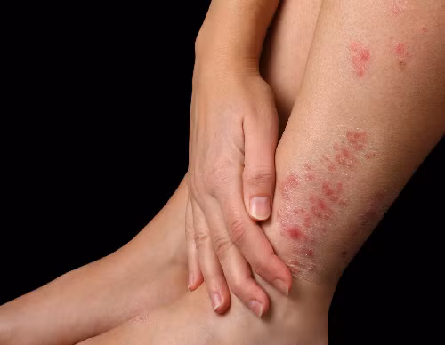 Chữa nấm chân: Để điều trị nấm bàn chân, bạn có thể sử dụng bột sầu đâu để làm dịu tình trạng kích ứng da. Ảnh: Bài thuốc.