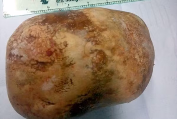 Choáng váng viên sỏi bàng quang nặng 1,5kg trong cơ thể Choang vang vien soi bang quang nang 1,5kg trong co the