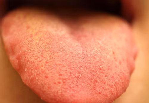 Nguyên nhân của tính trạng này được lý giải là do trong quả dứa có chứa chất glycoside gây ra những kích thích đến vùng da hay niêm mạc miệng khi bạn ăn dứa vào cơ thể. Ảnh: Sống khỏe.