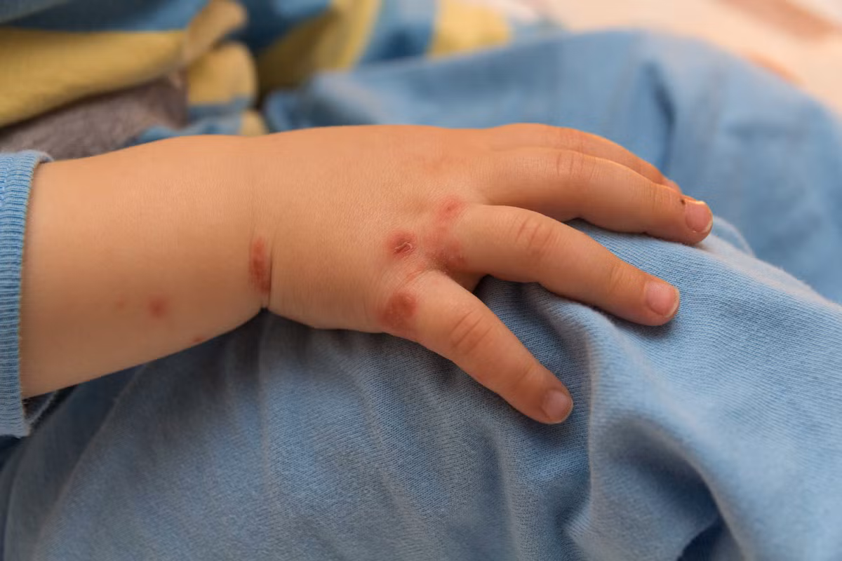 Tuy nhiên trên thực tế, bệnh chân tay miệng là bệnh dễ lây, dễ tái phát, chưa có thuốc ngừa cũng như thuốc đặc trị và có nguy cơ gây biến chứng tử vong rất cao. Ảnh: Hellobacsi.