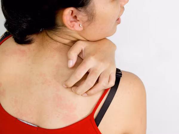 Thường xuyên bị ngứa và nổi mẩn khắp trên da trong một số trường hợp cũng là dấu hiệu cảnh báo sớm bệnh ung thư. Khi bạn bị ung thư nhất là ung thư da hệ thống miễn dịch của bạn sẽ bắt đầu phải chiến đấu với những tác nhân gây bệnh, việc này sẽ làm tăng lưu lượng máu tới vùng da bị bệnh khiến da bạn nhạy cảm hơn và dễ ngứa ngáy hơn.