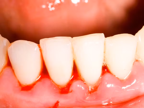 Tình trạng chảy máu bất thường ví dụ như chảy máu chân răng, chẳng máu tử cung, chảy máu núm vú đều vô cùng nguy hiểm cần phải cẩn trọng.